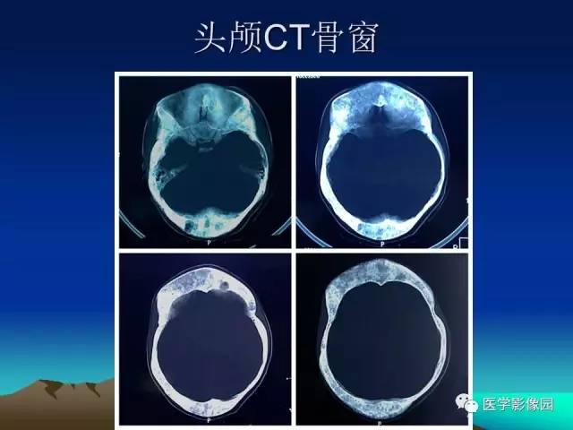 【病例】McCune-Albright 综合征1例CT及MR