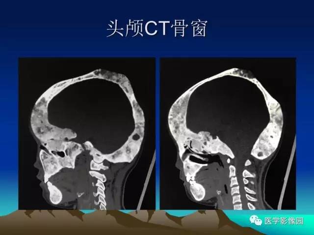 【病例】McCune-Albright 综合征1例CT及MR