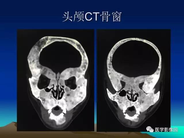 【病例】McCune-Albright 综合征1例CT及MR