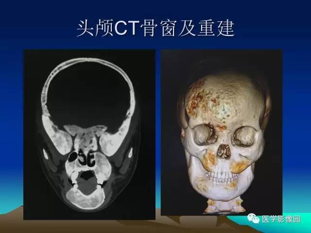 【病例】McCune-Albright 综合征1例CT及MR