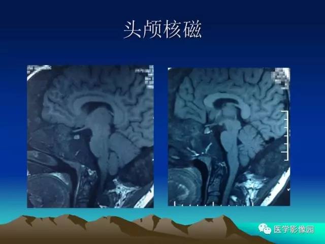 【病例】McCune-Albright 综合征1例CT及MR