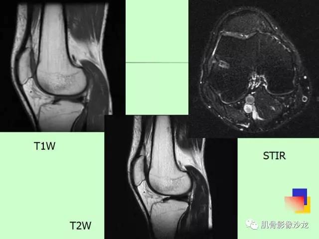 【PPT】骨骼肌肉系统疾病MRI诊断基础