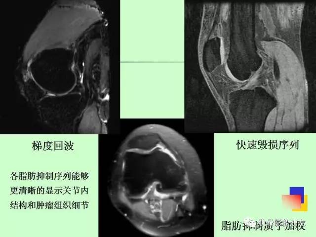 【PPT】骨骼肌肉系统疾病MRI诊断基础