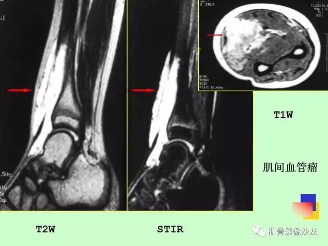 【PPT】骨骼肌肉系统疾病MRI诊断基础