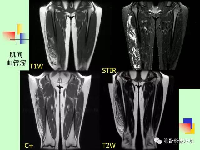 【PPT】骨骼肌肉系统疾病MRI诊断基础