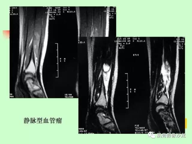 【PPT】骨骼肌肉系统疾病MRI诊断基础