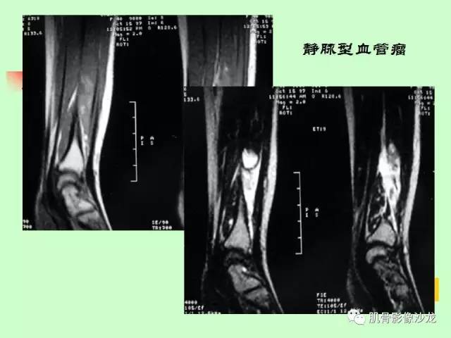 【PPT】骨骼肌肉系统疾病MRI诊断基础