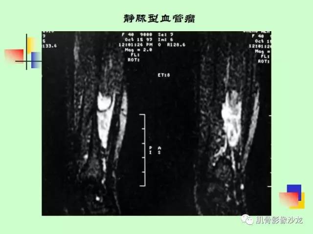 【PPT】骨骼肌肉系统疾病MRI诊断基础
