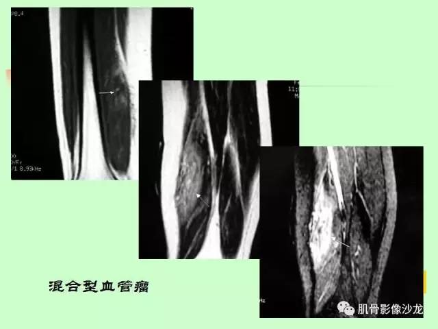 【PPT】骨骼肌肉系统疾病MRI诊断基础