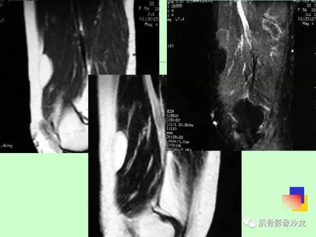 【PPT】骨骼肌肉系统疾病MRI诊断基础