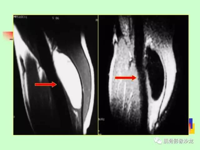 【PPT】骨骼肌肉系统疾病MRI诊断基础