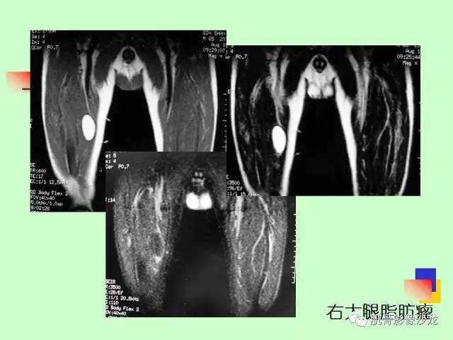 【PPT】骨骼肌肉系统疾病MRI诊断基础