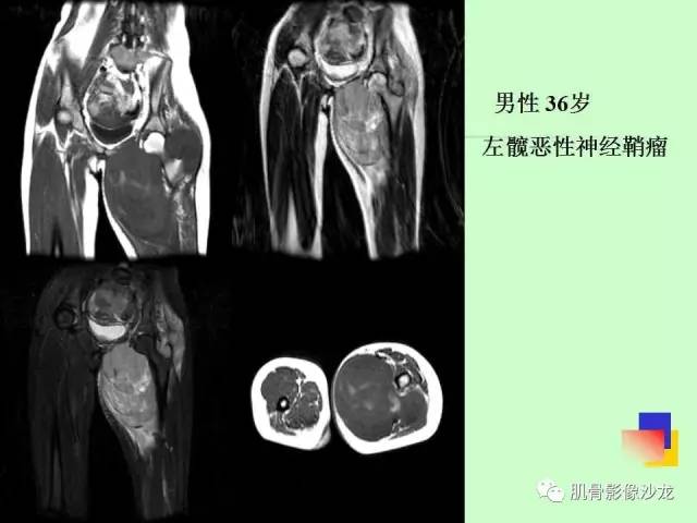 【PPT】骨骼肌肉系统疾病MRI诊断基础