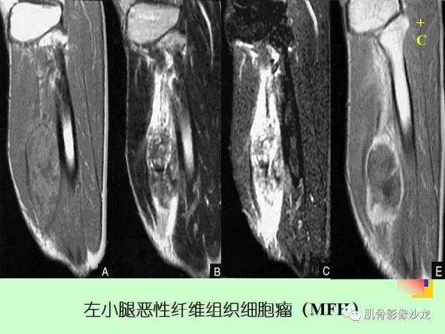 【PPT】骨骼肌肉系统疾病MRI诊断基础