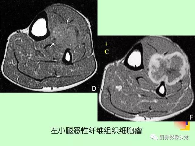 【PPT】骨骼肌肉系统疾病MRI诊断基础