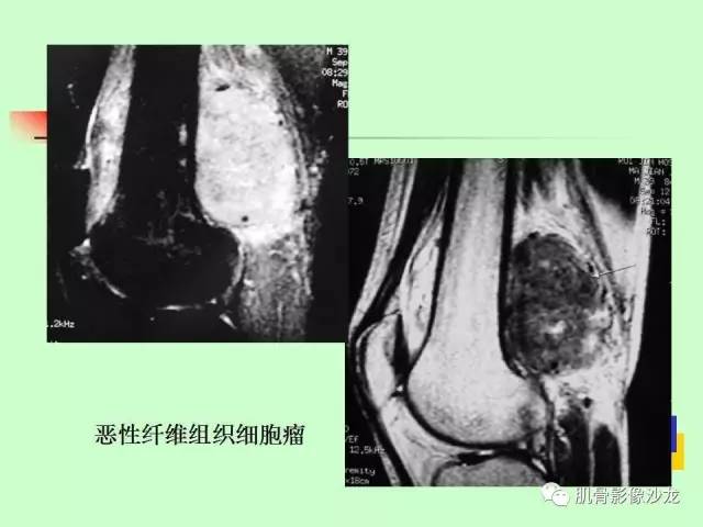 【PPT】骨骼肌肉系统疾病MRI诊断基础