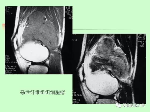 【PPT】骨骼肌肉系统疾病MRI诊断基础