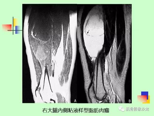 【PPT】骨骼肌肉系统疾病MRI诊断基础