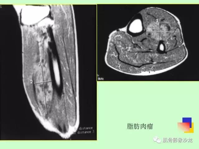 【PPT】骨骼肌肉系统疾病MRI诊断基础