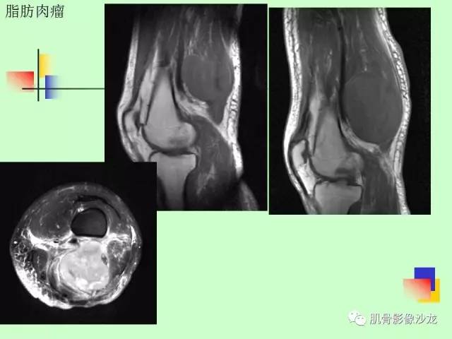 【PPT】骨骼肌肉系统疾病MRI诊断基础
