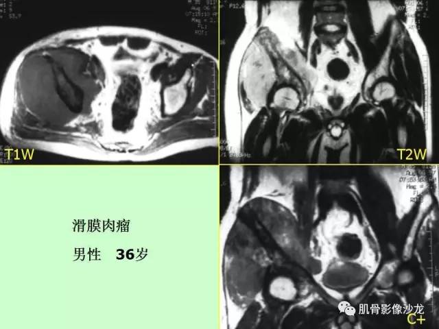 【PPT】骨骼肌肉系统疾病MRI诊断基础