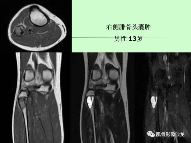 【PPT】骨骼肌肉系统疾病MRI诊断基础