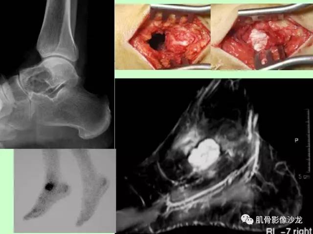 【PPT】骨骼肌肉系统疾病MRI诊断基础
