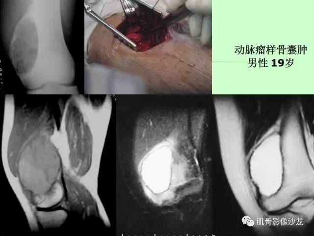 【PPT】骨骼肌肉系统疾病MRI诊断基础