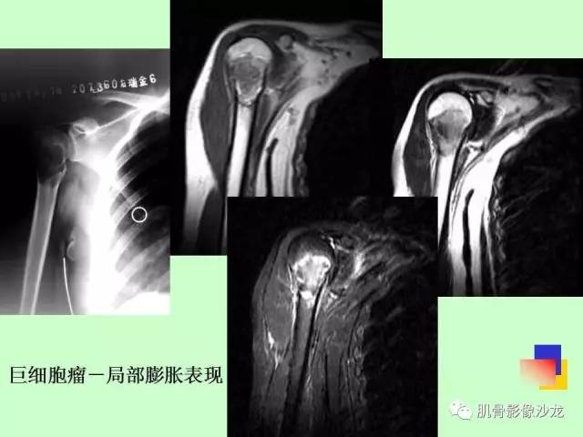【PPT】骨骼肌肉系统疾病MRI诊断基础