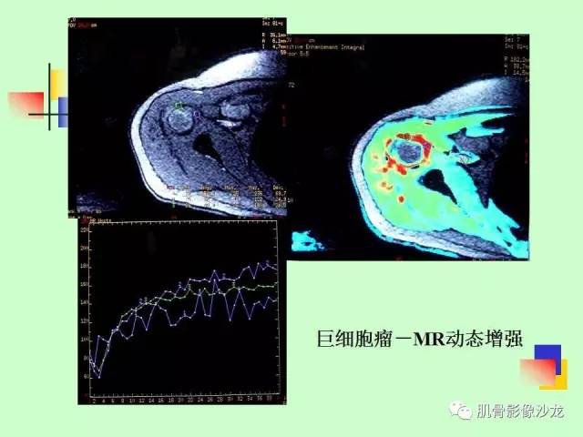 【PPT】骨骼肌肉系统疾病MRI诊断基础