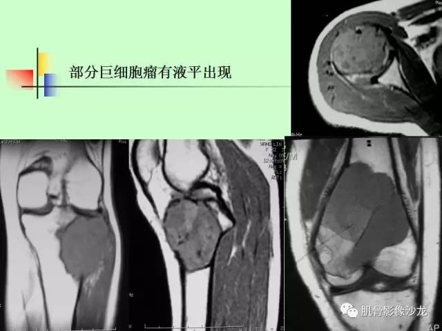 【PPT】骨骼肌肉系统疾病MRI诊断基础