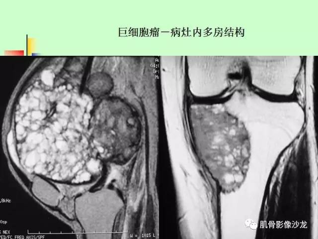 【PPT】骨骼肌肉系统疾病MRI诊断基础