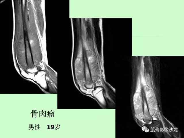 【PPT】骨骼肌肉系统疾病MRI诊断基础