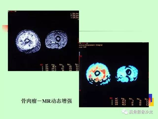 【PPT】骨骼肌肉系统疾病MRI诊断基础