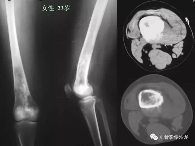 【PPT】骨骼肌肉系统疾病MRI诊断基础