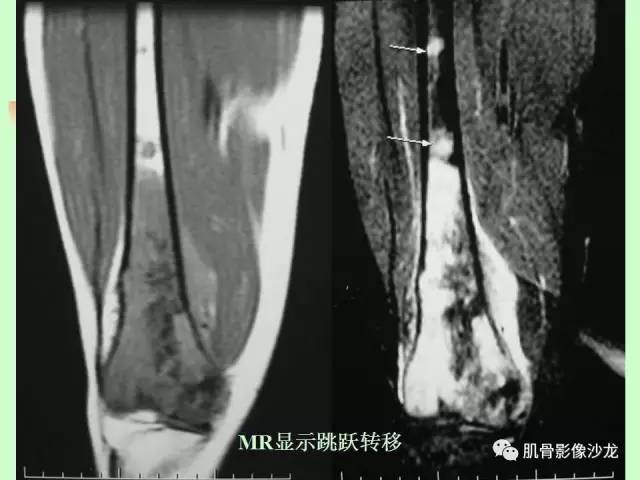 【PPT】骨骼肌肉系统疾病MRI诊断基础