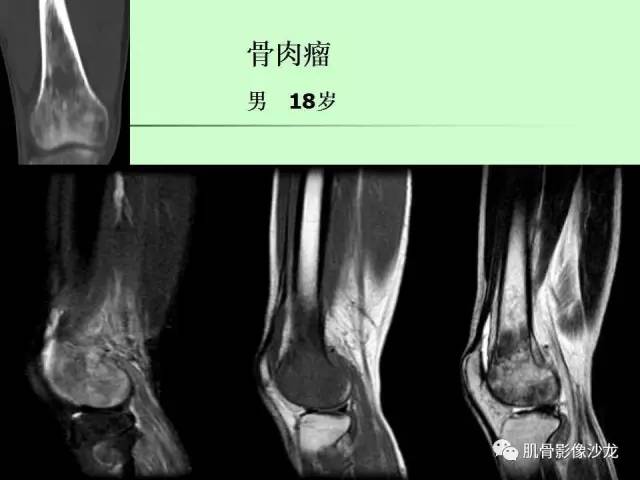 【PPT】骨骼肌肉系统疾病MRI诊断基础