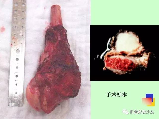 【PPT】骨骼肌肉系统疾病MRI诊断基础