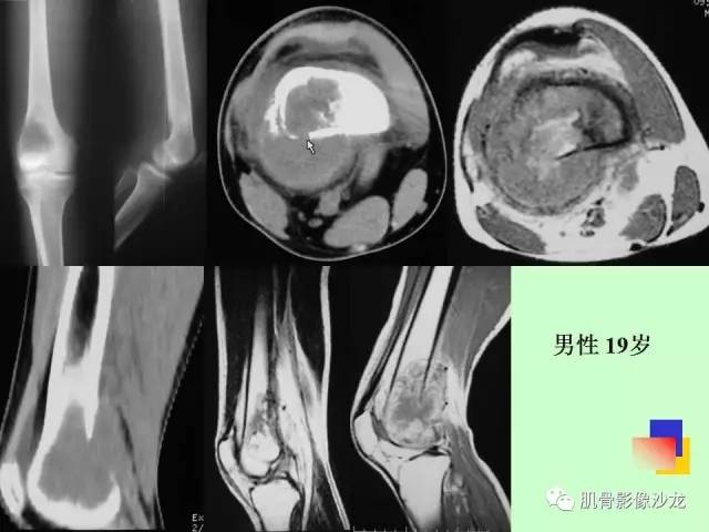 【PPT】骨骼肌肉系统疾病MRI诊断基础
