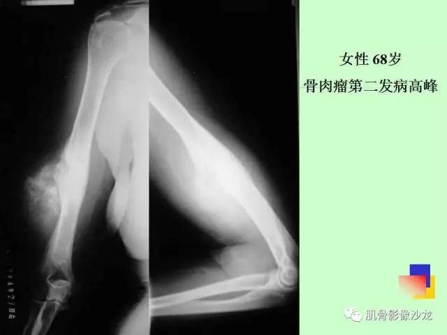 【PPT】骨骼肌肉系统疾病MRI诊断基础