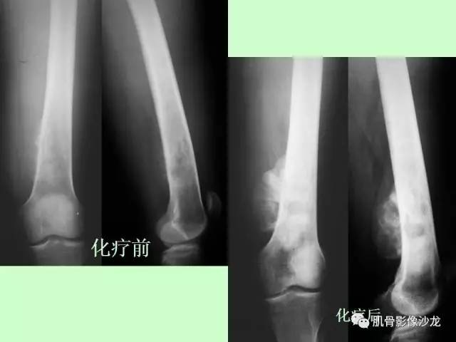 【PPT】骨骼肌肉系统疾病MRI诊断基础