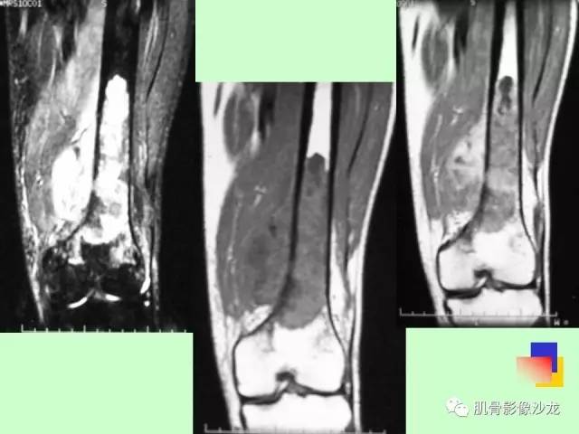 【PPT】骨骼肌肉系统疾病MRI诊断基础