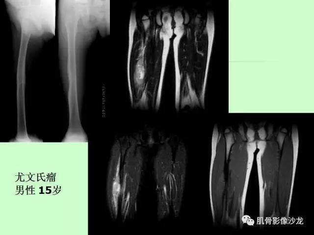 【PPT】骨骼肌肉系统疾病MRI诊断基础