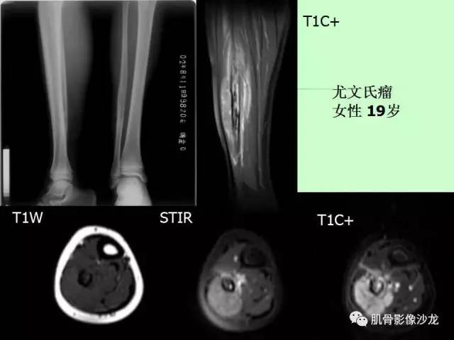 【PPT】骨骼肌肉系统疾病MRI诊断基础