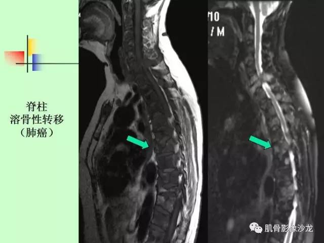 【PPT】骨骼肌肉系统疾病MRI诊断基础