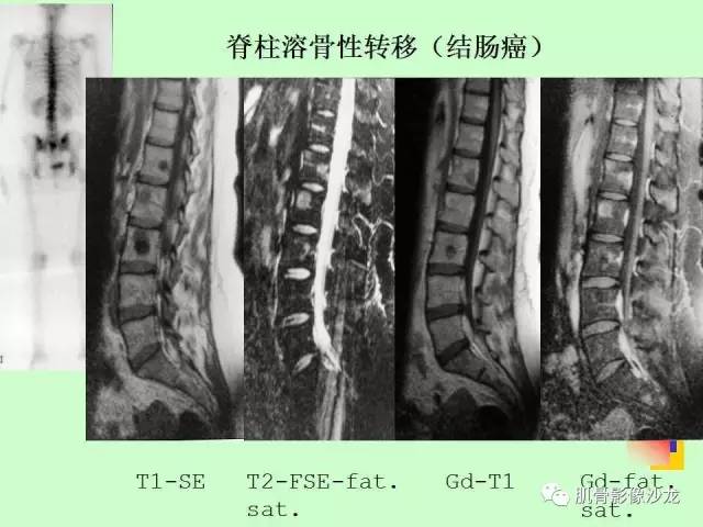 【PPT】骨骼肌肉系统疾病MRI诊断基础