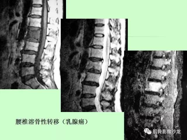 【PPT】骨骼肌肉系统疾病MRI诊断基础