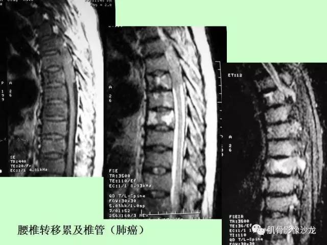 【PPT】骨骼肌肉系统疾病MRI诊断基础