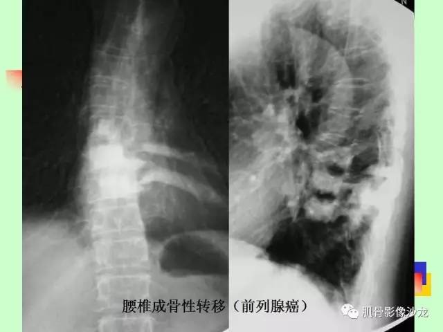 【PPT】骨骼肌肉系统疾病MRI诊断基础