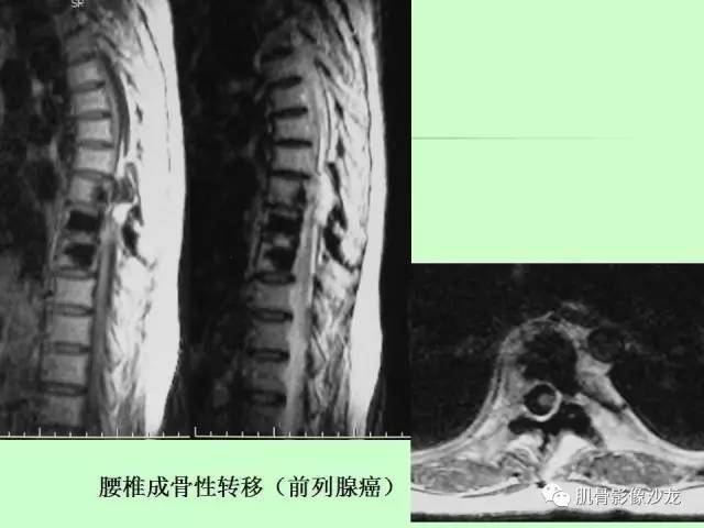 【PPT】骨骼肌肉系统疾病MRI诊断基础